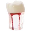 MOLAR CON CONDUCTOS RADICULARES