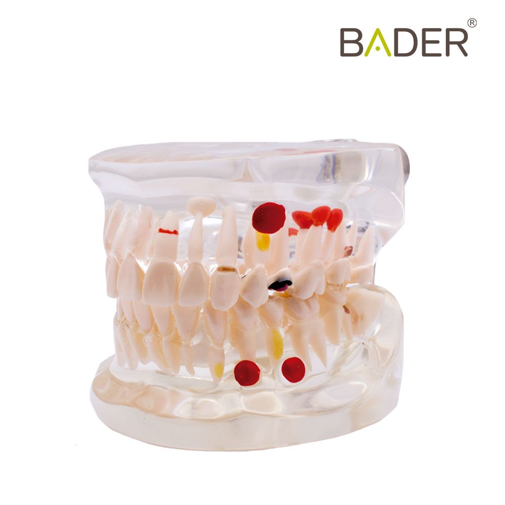 MODELO DENTAL TRANSPARENTE CARIES