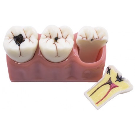 [0905101] MODELO DEMOSTRACIÓN DESMONTABLE CON CARIES